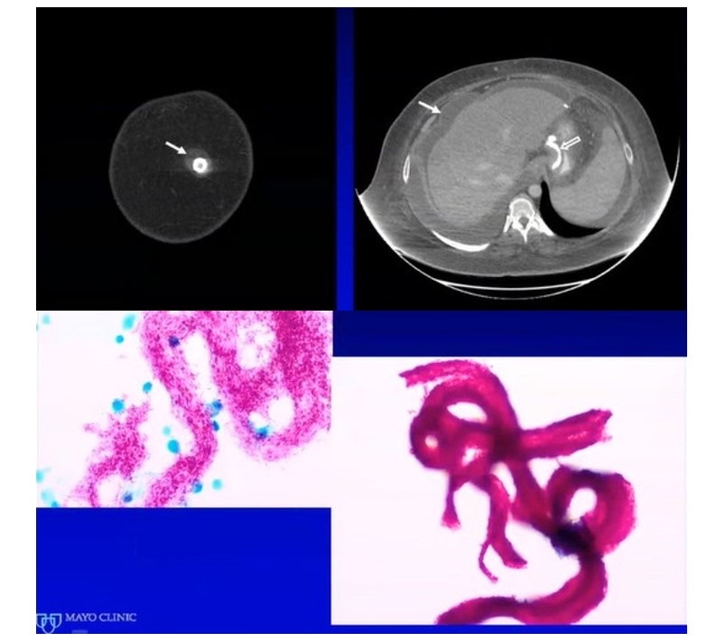 Mayo Clinic Infectious Diseases tweet media