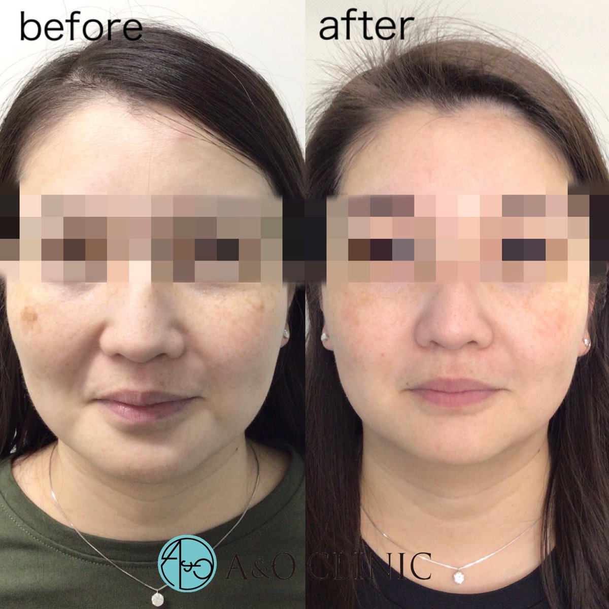 aoclinic_o's tweet photo. ピコスポット＋フォトフェイシャル 症例写真🤳

ピコスポット照射から2ヶ月半経過し、その後定期的にフォトフェイシャルを照射。
頬骨上のシミが薄くなり、フォトフェイシャルの効果で色むら改善、スキントーンUP！

M22
初回 ¥19,800〜 https://t.co/ItaWVckm0u