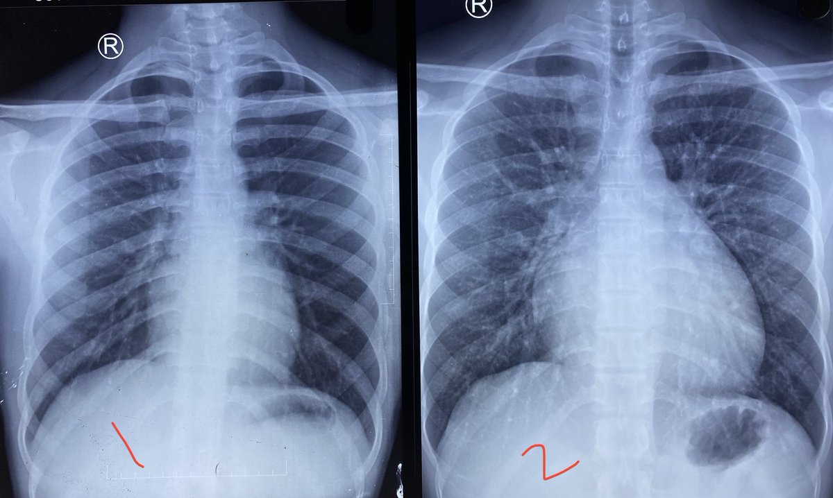 For card fellows. 21 yr old male, X-ray 1 was taken 3 months back for evaluation of fever and cough. Echo then reported as “normal”. Now admitted with progressive effort dyspnoea of 2 months in class III now. His pulse is “bounding”. See X-ray 2 and what are your differentials?