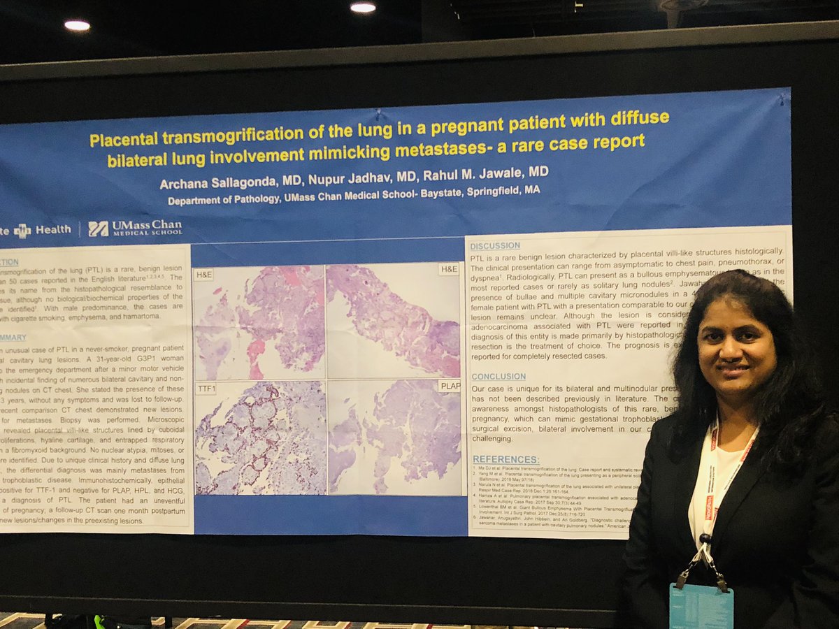 Dr.Archana Reddy (@archana_reddy2) on Twitter photo Day 2 Poster No.2 Thank you #CAP22 for giving an opportunity to present our work and represent <a href="/Baystate_Health/">Baystate Health</a> #PathTwitter #pathology Day 2 Poster No.2 Thank you #CAP22 for giving an opportunity to present our work and represent <a href="/Baystate_Health/">Baystate Health</a> #PathTwitter #pathology