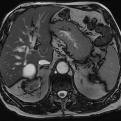 AuntMinnieEuro's tweet photo. A new study suggests #pancreaticcancer remains a difficult diagnosis. In 600 confirmed cases, 46 patients failed to have their cancer diagnosed on their initial scan, representing a missed cancer rate of 7.7%. https://t.co/NIWRExR1T9 #radiology #uegweek #esgar @nosheenmujeeb https://t.co/S1VU7Jyh8b