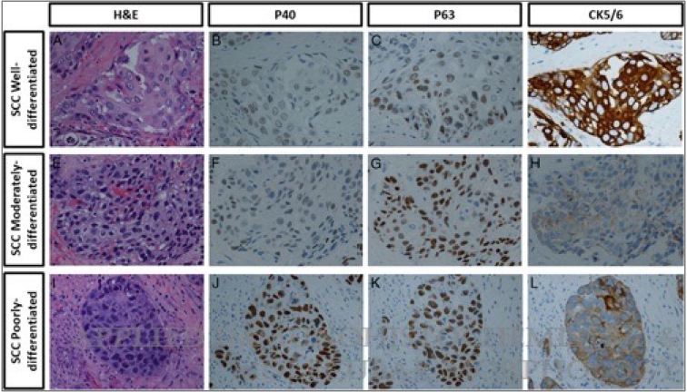 Appl Immunohistochem Mol Morphol Journal (@aimmjournal) on Twitter photo Variations of P40 and P63 #IHC in Different
Grades of Esophageal Squamous Cell Ca:
A Potential Diagnostic Pitfall ❗️
- P40 and P63 expression lower in well-diff SCC compared to higher grade
#GIpath #IHCpath
journals.lww.com/appliedimmunoh…
<a href="/Purvago/">Purva Gopal</a> <a href="/SuntreaHammer/">Suntrea Hammer</a> <a href="/UTSW_GIpath/">UTSW GI Pathology</a> Variations of P40 and P63 #IHC in Different
Grades of Esophageal Squamous Cell Ca:
A Potential Diagnostic Pitfall ❗️
- P40 and P63 expression lower in well-diff SCC compared to higher grade
#GIpath #IHCpath
journals.lww.com/appliedimmunoh…
<a href="/Purvago/">Purva Gopal</a> <a href="/SuntreaHammer/">Suntrea Hammer</a> <a href="/UTSW_GIpath/">UTSW GI Pathology</a>