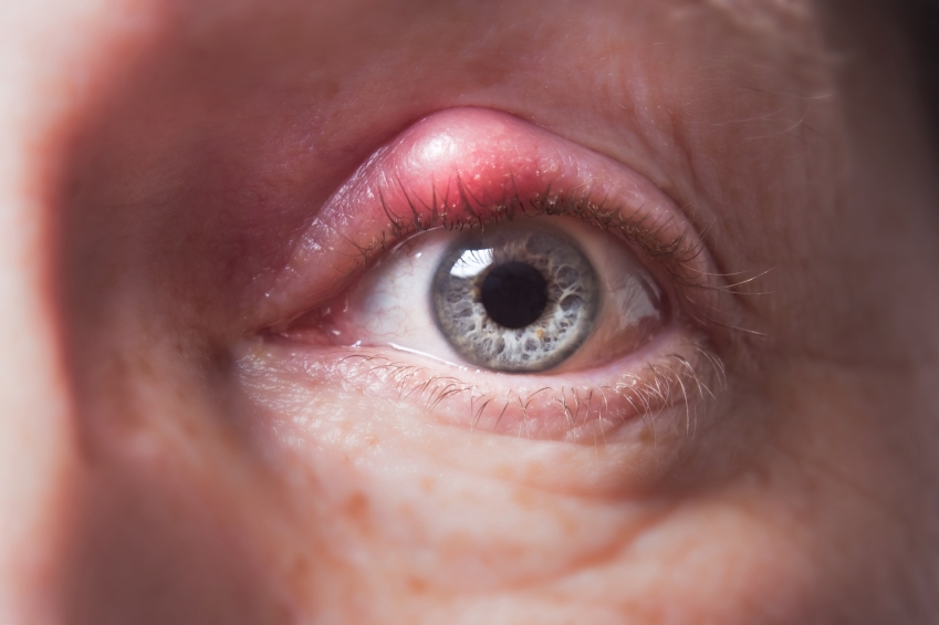 Eastbourne Eye Surgeon (@eyesurgery1) on Twitter photo What are the symptoms of Chalazion? #eyehealth #Chalazion #EastSussex ow.ly/WSuy30sr1Lv What are the symptoms of Chalazion? #eyehealth #Chalazion #EastSussex ow.ly/WSuy30sr1Lv