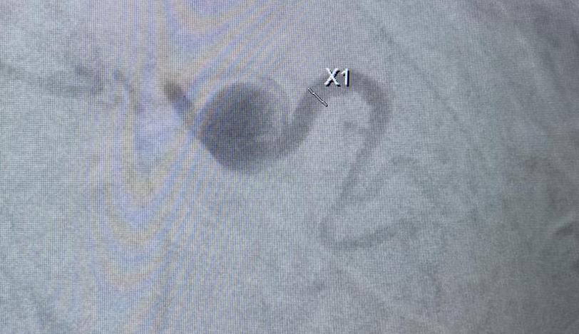 BaltSpain's tweet photo. El pasado miércoles realizamos el Workshop de Endoleaks Embolization, queremos agradecer al Dr. @federicozarco, al Dr. Riambau Vincent, al @hospitalclinic y a todos los asistentes.
#baltspain #embolization #endoleaks #interventionalradiology #radiología #peripheralembolization https://t.co/07whqtAzA4