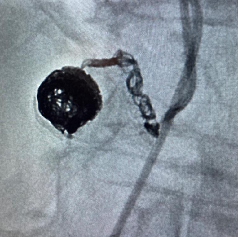 BaltSpain's tweet photo. El pasado miércoles realizamos el Workshop de Endoleaks Embolization, queremos agradecer al Dr. @federicozarco, al Dr. Riambau Vincent, al @hospitalclinic y a todos los asistentes.
#baltspain #embolization #endoleaks #interventionalradiology #radiología #peripheralembolization https://t.co/07whqtAzA4