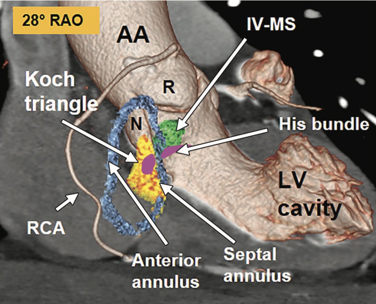 Fibrous Skeleton of the Heart and Adjacent Structures. 
doi.org/10.1148/rg.201…