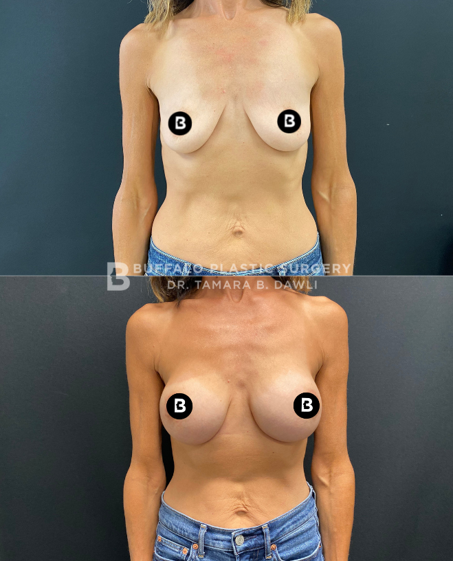 drtamaradawli's tweet photo. If you got it flaunt it #BreastAug😍
📸Shared with patient permission
📞 Phone: 716.821.2935
🖥️ Website: https://t.co/Eu8z5xrJvh
#buffaloplasticsurgery #boardcertifiedplasticsurgeon #buffalony #drdawli #fulllook #breastlift #breastaug #breastimplants #breastsurgeon https://t.co/GeSmaJvTny