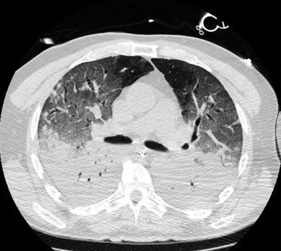 otavio_ranzani's tweet photo. Como diagnosticamos pneumonias graves na UTI?

Você é médica ou médico e trabalha em UTI? 
Participe desta survey internacional 👇

É muito importante termos representatividade do Brasil e outros países da América Latina.

Por favor, ajude a divulgar e RT!
https://t.co/WObe5mFX6k https://t.co/e556hy5OFq