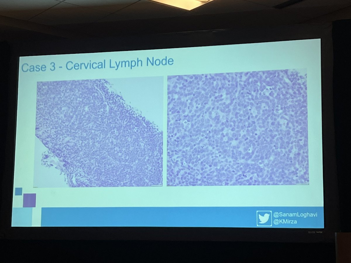 Adam L. Booth, MD (@alboothmd) on Twitter photo “The ABC (and GCB) of Large B-Cell Lymphomas: An Algorithmic Approach to the Workup of Large B-Cell Lymphomas for the Surgical Pathologist”
Practical updates and review by <a href="/sanamloghavi/">Sanam Loghavi, MD صنم لغوی 🔬🧬</a> <a href="/KMirza/">Kamran Mirza MD PhD - کامران مرزا</a> #hemepath #cap22 “The ABC (and GCB) of Large B-Cell Lymphomas: An Algorithmic Approach to the Workup of Large B-Cell Lymphomas for the Surgical Pathologist”
Practical updates and review by <a href="/sanamloghavi/">Sanam Loghavi, MD صنم لغوی 🔬🧬</a> <a href="/KMirza/">Kamran Mirza MD PhD - کامران مرزا</a> #hemepath #cap22