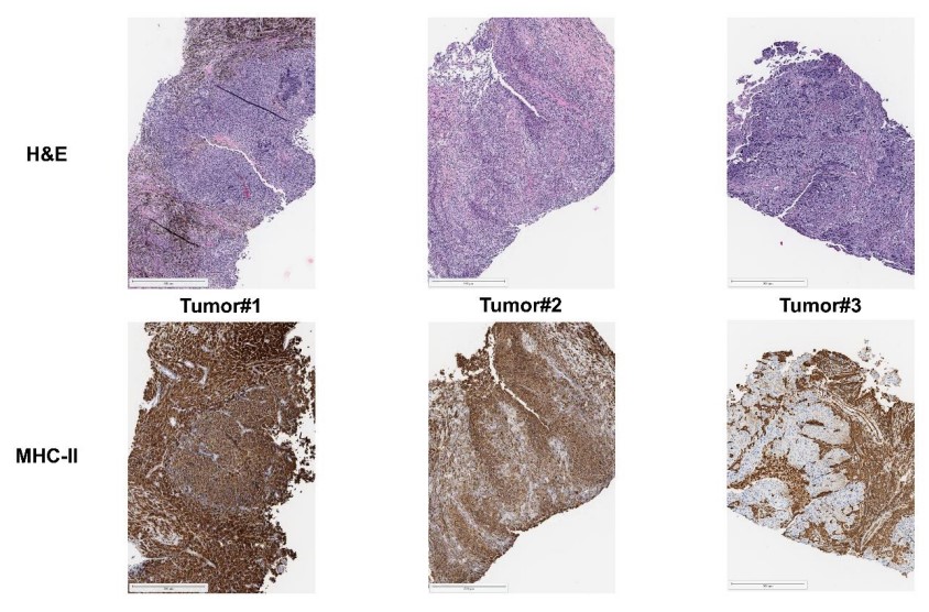 CIR_AACR's tweet photo. Check out how #melanoma acquires resistance to multiple lines of #immunotherapy by gaining consecutive alterations, resulting in pan T-cell immune escape. By Nielsen, @MarioPre_, Svane, @DoniaMarco et al.
https://t.co/Ww9FZlzRew
@AriannaDraghi @CAChamberlain_ @Michael44364760 https://t.co/U93Yj5Gtjh