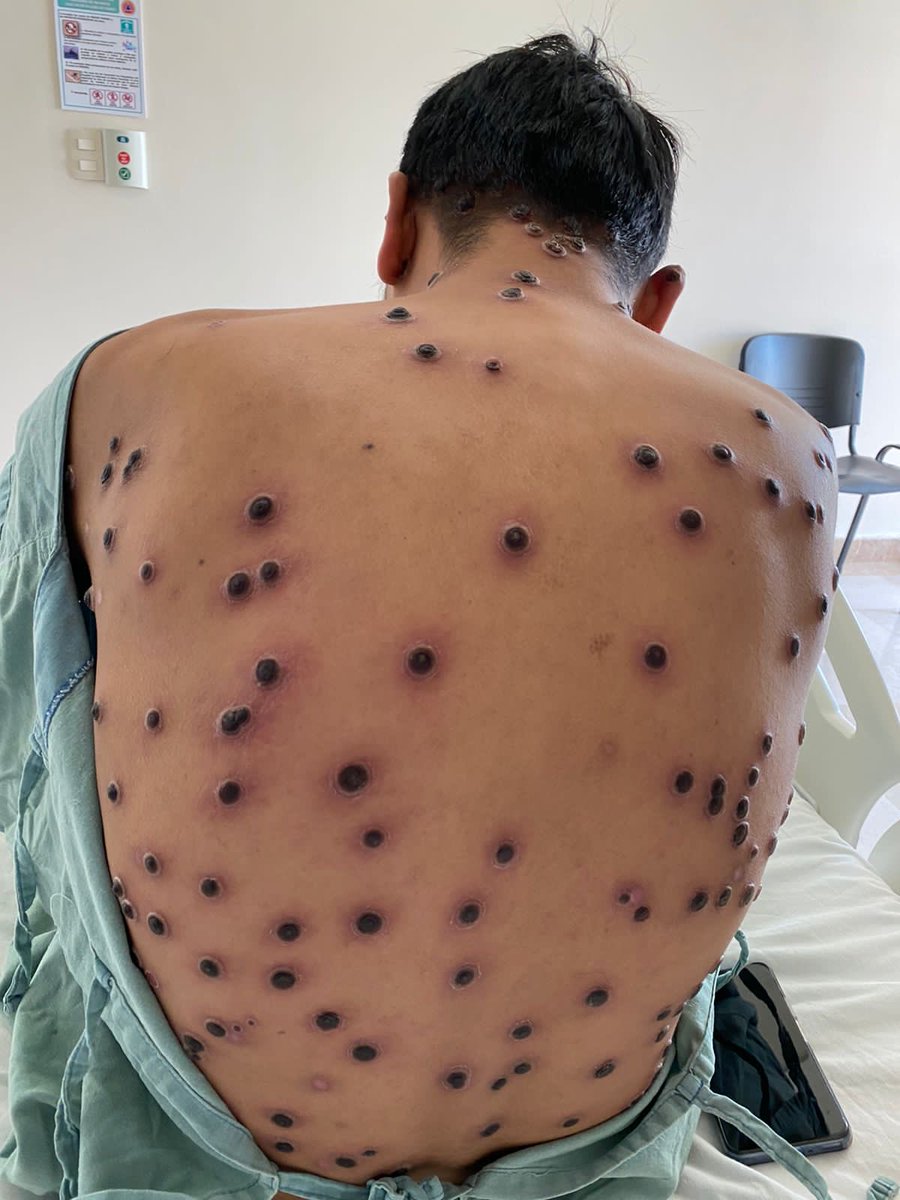 JeronimoHiram's tweet photo. Un caso grave de VS con más de 250 lesiones y sobre infección https://t.co/Siy67Piza6