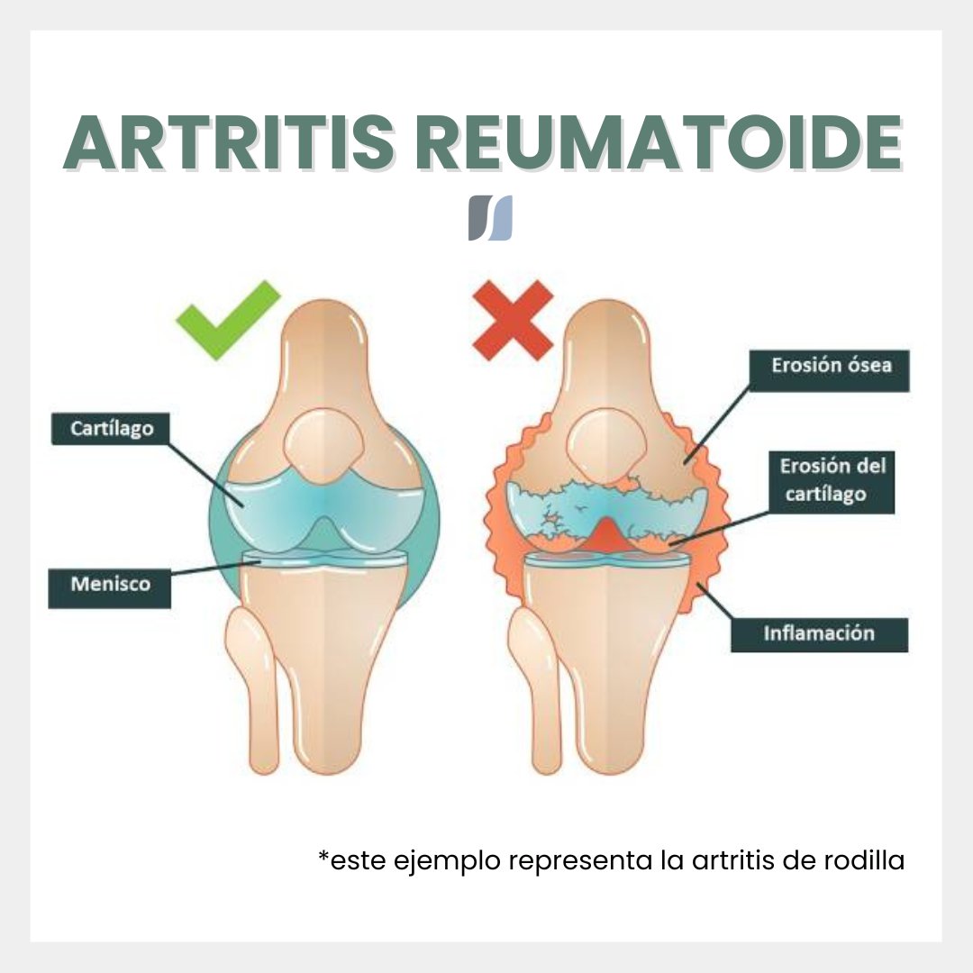 fisycCC's tweet photo. Artritis reumatoide una grave enfermedad ❌... pero, ¿sabías que?.. 

Te informamos de más:
Instagram: https://t.co/uf4hhYaVbj

Facebook: https://t.co/mAkTvliDqk

#articulación #articulaciones #artritisreumatoide  #fisioterapia  #hábitos #enfermedad https://t.co/dWSchafbnS