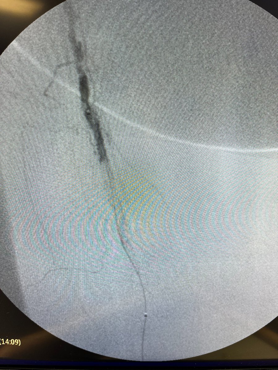 Revascularize's tweet photo. Another great case with the Biotronik Pulsar T3 stent.  The 4Fr tri-axial system allows precise delivery along with an excellent crossing profile - a game changing technology especially when treating from a retrograde pedal approach. @BIOTRONIK_US @CLI_Global https://t.co/xP3hCoNnpQ