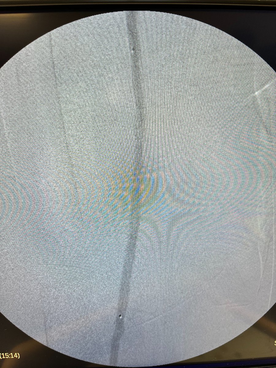 Revascularize's tweet photo. Another great case with the Biotronik Pulsar T3 stent.  The 4Fr tri-axial system allows precise delivery along with an excellent crossing profile - a game changing technology especially when treating from a retrograde pedal approach. @BIOTRONIK_US @CLI_Global https://t.co/xP3hCoNnpQ