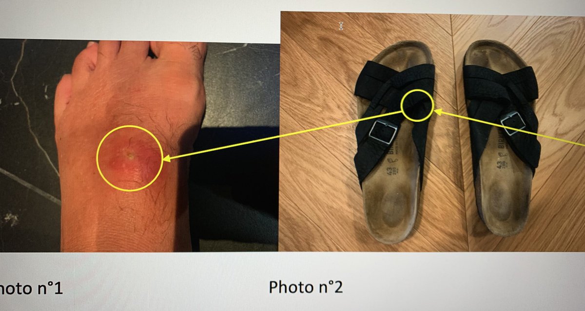 LaLoupe3's tweet photo. Après une grave infection sur mon pied suite au port d’une paire de @BIRKENSTOCKUSA neuve , @Veepee_Fr botte en touche pour éviter tout dédommagement malgré des preuves médicales irréfragables ! C’est choquant ! @JAGventeprivee @ChPawlowski @The_best_man_57 https://t.co/bvJ3DHHIt0