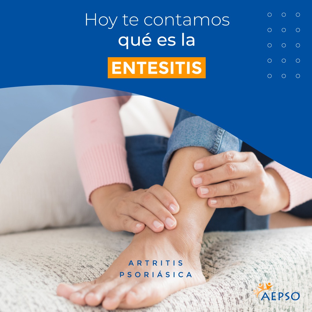 AEPSOarg's tweet photo. 🤔 Hoy te contamos qué es la 𝒆𝒏𝒕𝒆𝒔𝒊𝒕𝒊𝒔
ℹ La 𝒆𝒏𝒕𝒆𝒔𝒊𝒕𝒊𝒔 es la inflamación de la 𝘦𝘯𝘵𝘦𝘴𝘪𝘴, el lugar donde se unen los tendones y los ligamentos con el hueso
@silviafbarrio @ComunidadSar @soarpso @PsoriasisIFPA
#entesitis #artritispsoriasica #aepso https://t.co/JXkt7ke7lx