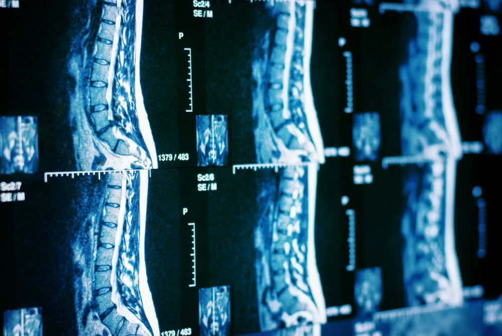 Once viewed as the “graveyard of neuroscience,” the field of spinal cord injury has made remarkable progress thanks to the Christopher &amp; Dana Reeve Foundation. We check in with two leaders to discuss challenges and opportunities. Mike Scutari reports: bit.ly/3ywEeen