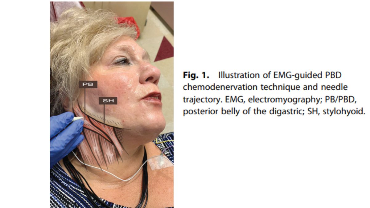 VUMC Otolaryngology–Head and Neck Surgery (@vanderbiltent) on Twitter photo Authors of this retrospective review found #synkinesis patients with jaw tightness or swallow discomfort may benefit from the addition of PBD injections to the therapeutic regimen.
<a href="/LizLonginoMD/">Elizabeth S. Longino MD</a> @kclandeenmd <a href="/kskimura/">Kyle Kimura, MD</a> <a href="/RahulKSharmaMD/">Rahul K. Sharma, MD</a> <a href="/shiyangmd/">Shi Yang, MD</a> liebertpub.com/doi/10.1089/fp… Authors of this retrospective review found #synkinesis patients with jaw tightness or swallow discomfort may benefit from the addition of PBD injections to the therapeutic regimen.
<a href="/LizLonginoMD/">Elizabeth S. Longino MD</a> @kclandeenmd <a href="/kskimura/">Kyle Kimura, MD</a> <a href="/RahulKSharmaMD/">Rahul K. Sharma, MD</a> <a href="/shiyangmd/">Shi Yang, MD</a> liebertpub.com/doi/10.1089/fp…