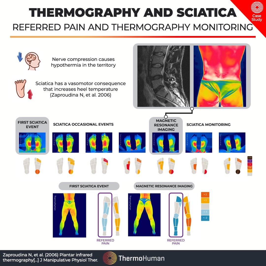 ThermoHuman's tweet photo. ๐ฌ๐ง
๐ธ #Thermography allows identifying the consequences of different conditions, such as #sciaticapain.
๐ฅ This is due to its close relationship with the #thermalpatterns that it causes as it is a #musculoskeletal #pathology that implies a nervous compromise.
(โฆ) https://t.co/YOTFCLRuiO