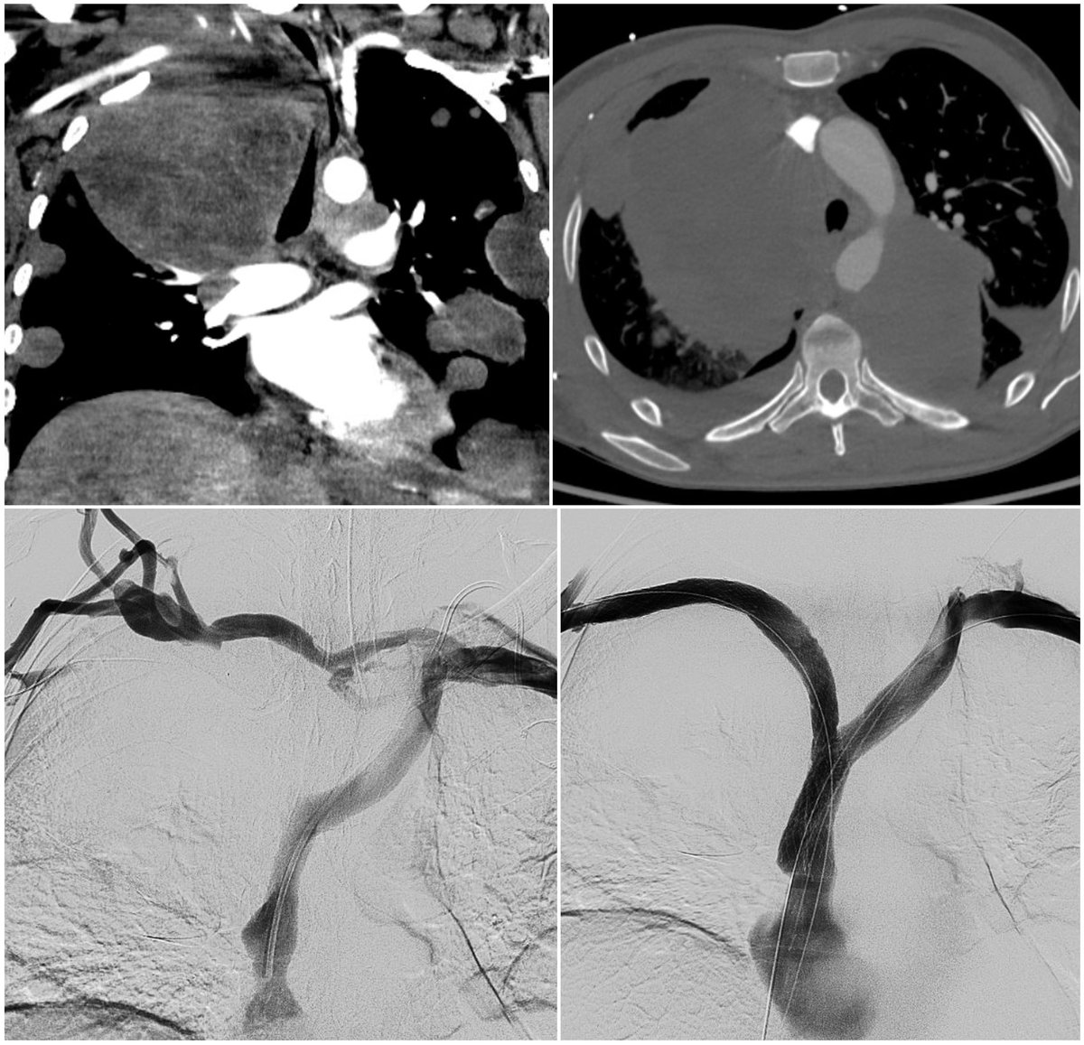 Venous reconstruction of the upper extremity and thoracic central veins provides near-immediate improvement for patients with malignancy-associated superior vena cava (SVC) syndromes. <a href="/davidsshin/">David Shin</a> <a href="/mabadsantos/">Matt Abad-Santos</a> <a href="/UofWa_IR/">University of Washington IR Residency</a> <a href="/SIRspecialists/">Society of Interventional Radiology</a> <a href="/SIRRFS/">SIR RFS</a> <a href="/SIR_ECS/">SIR ECS</a> <a href="/cirsesociety/">CIRSE</a> <a href="/_backtable/">BackTable Vascular and Interventional</a>