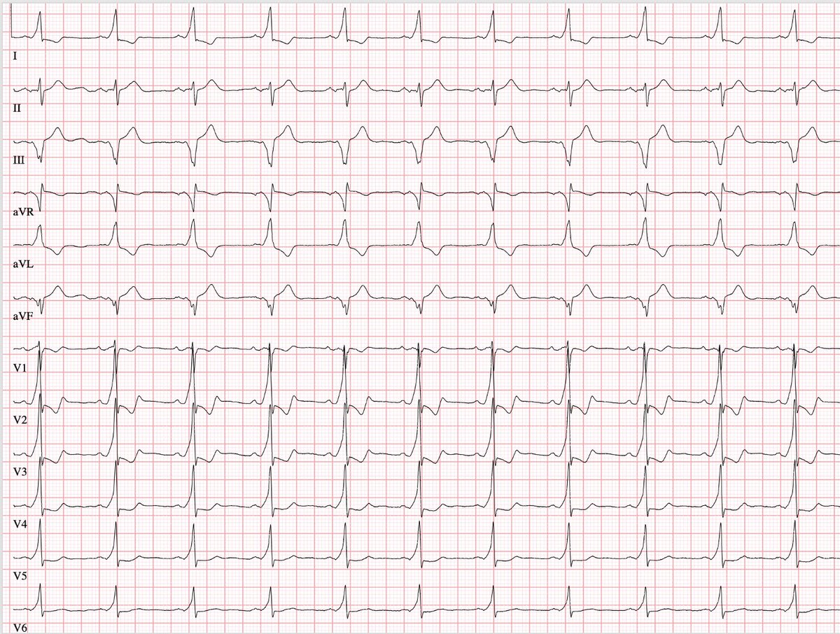 veramasloo's tweet photo. 34yo, male, hospital admission with palpitations.#EPeeps  guess the location of AP! As always, mapping and ablaiton are coming soon😉 @evgeny_lyan @ThomasDemming #EP_Kiel #CardioTwitter #FOAMed #Fellowsfirst https://t.co/76l1JQAVrD