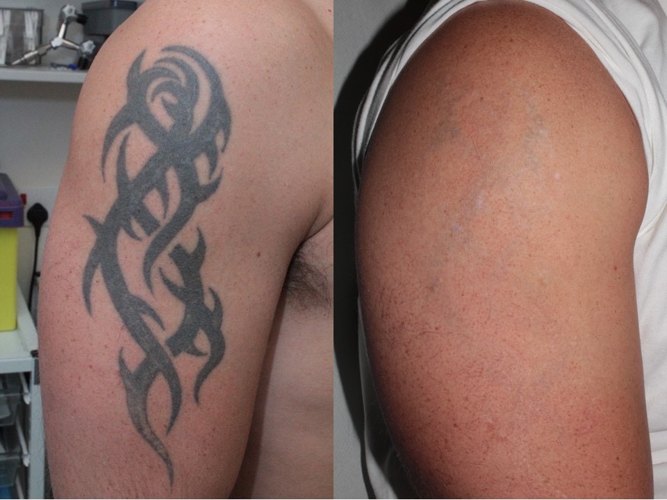 SalisburyLaser's tweet photo. You know I said yday “Come and get your tattoo removed”. This is one of our recent results after 5 treatments: https://t.co/Gsu7DNMQ7x