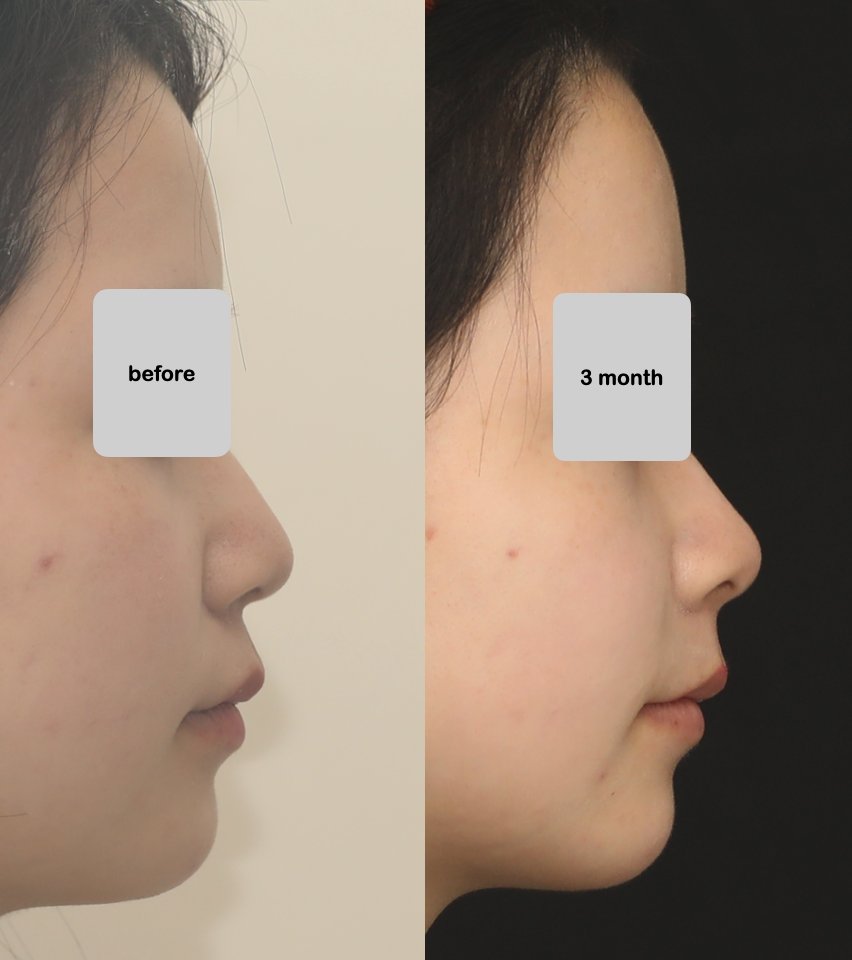 dds_cozy's tweet image. 自然な立体感
「A点+α手術：３ヶ月検診」

前方移動は
鼻柱基部 4mm
鼻先 1.5mm

リスク：腫れ、アップノーズetc