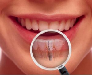 İmplant Diş tedavisi
İmplant, eksik olan dişlerin fonksiyon ve estetiğini sağlamak amacıyla çene kemiğine yerleştirilen ve 
#implant #implantdiş #implantdiştedavisi #birgündeimplant #implantdişnişantaşı #ömerkutay
omerkutay.com/implant