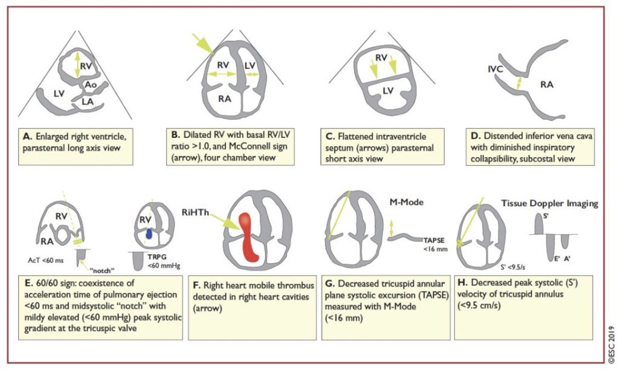 mmarin12's tweet image. Que buscar cuando se piensa en TEP…