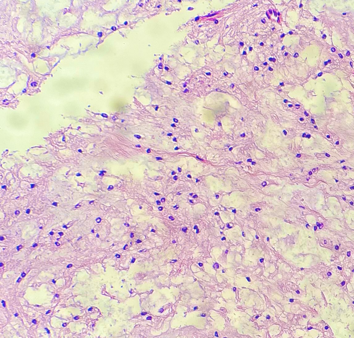 47 yo man with persistent pain in the low back area.
• CT lower back: 4.3 cm sacral mass
• IHC: S100, EMA, Brachyury +ve
What are your thoughts?🔬
#PathTwitter #PathologyResidents #BSTPathology #MedTwitter