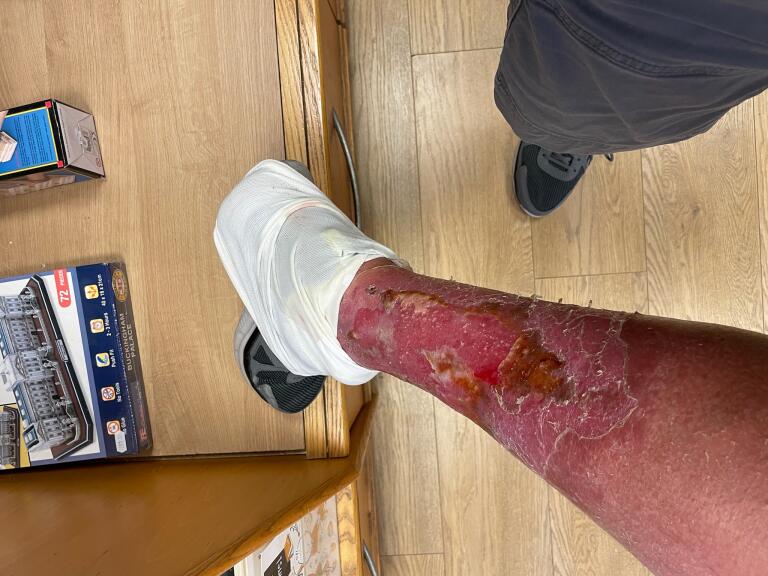Heatherjaney1's tweet photo. @DrMohammadIAdi1 Could this be vaccine damage? My brother has been fobbed off by numerous doctors for 6 months and still no diagnosis. https://t.co/o1v8Ld4Qvy