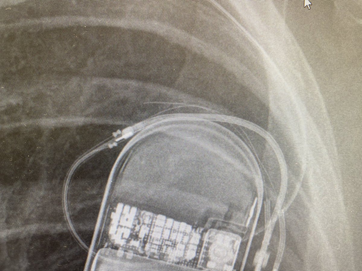 Patient for lead revision today surprised with this intraoperative finding. Anybody else experienced this?
DF1 dual coil lead implanted in 2017.
<a href="/clementy_ep/">Nicolas Clementy</a> @LukerJakob <a href="/SamuelSossalla/">Samuel Sossalla</a> <a href="/Leonard_Bergau/">Leonard Bergau</a> <a href="/ViclouiseJ/">Victoria Johnson</a> <a href="/YoungDgk/">Young DGK</a> <a href="/AGEP_DGK/">AGEP</a>