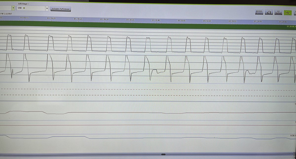 Severe COPD patient, Paco2 48mmhg under niv…the zero line is badly calculated by the software or massive autoEpap? The inefective efforts confirm that it is autoPep…what to do? That’s another question😨