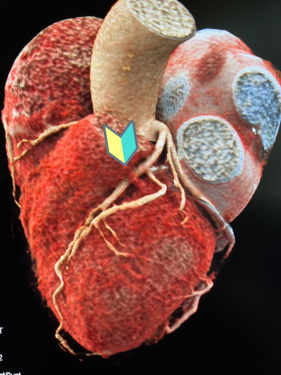 #YesCCT @Heart_SCCT @escardio Myocardial bridge (limited muscle band).. almost as though it wants to strangle the LAD ❓❓How would u treat in a symptomatic patient❓❓ @Steph_Achenbach @VDelgadoGarcia @AChoiHeart @purviparwani @ahmedalsaileek @Ahmed43101178 @imagingmedsci