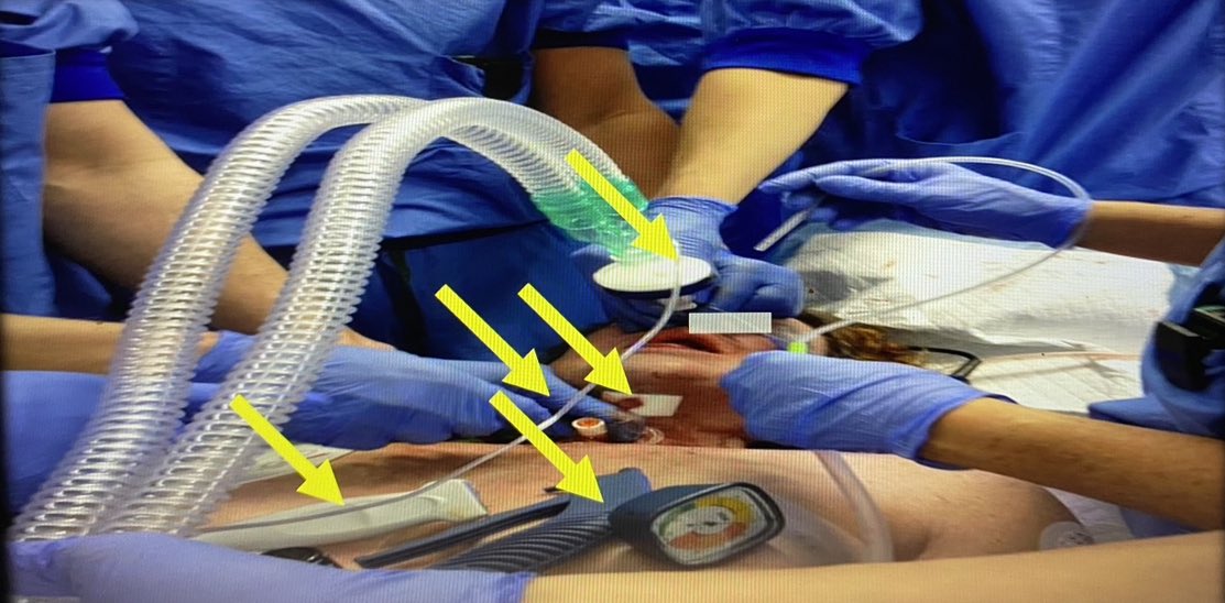 Hans Huitink on Twitter "☑️This…is end phase of a “cannot intubate