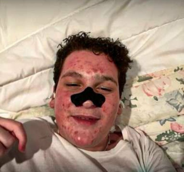 Banishedjourmo's tweet photo. Monkey Pox claimed him 💀 https://t.co/tiJggyO16R