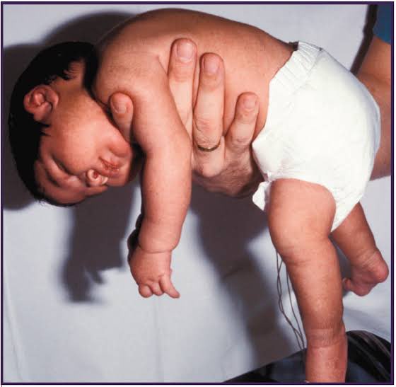 Jangan ngide ngasih serbuk kopi ke mulut bayi yg kejang ya. Berisiko banget karena kafein dalam kopi dpt meningkatkan detak jantung bayi! 😔
GA BOLEH juga bayi (usia 0-1 tahun) diberi madu krn berisiko infeksi botulisme. Kan biasanya mertua/orang tua ngasih madu pas bayi rewel 🥲