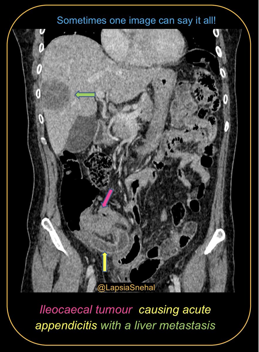 LapsiaSnehal's tweet image. Sometimes you get lucky and one image image can explain everything. #FOAMrad #FOAMed #meded  #radres #futureradres #medstudenttwitter #gitwitter #anatomy #frcr #surgery #radiology #radtwitter #medtwitter #emrad #colorectal #abdrad