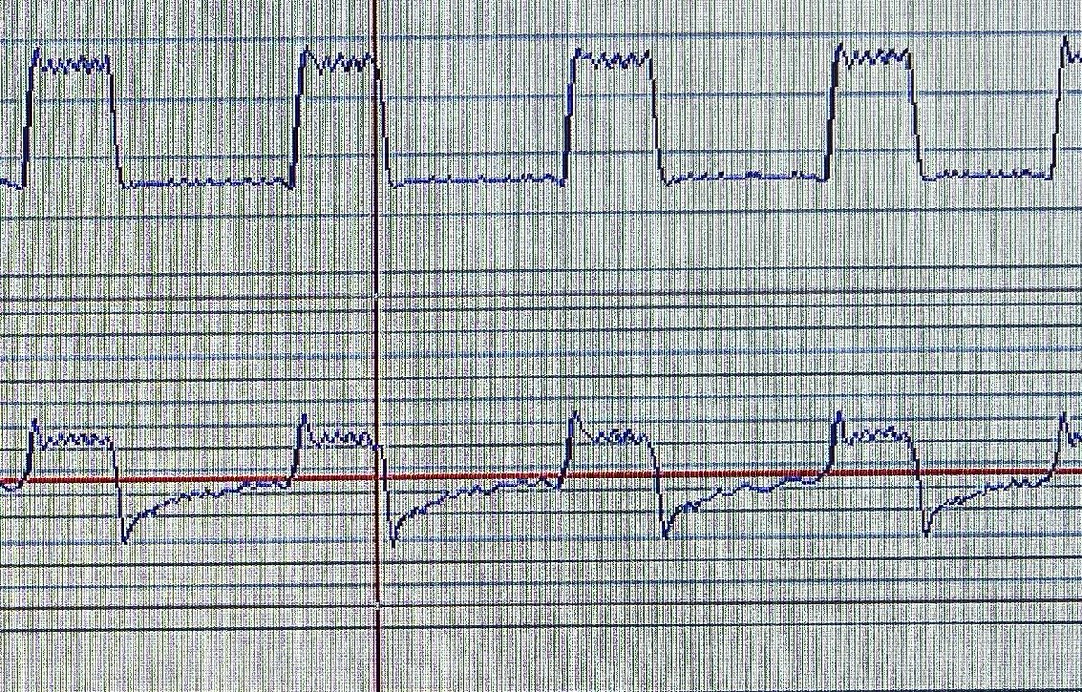 Snoring? Heart beat? Encumbrance?  Not so obvious….