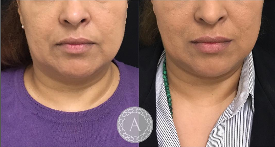 AestheticsAvika's tweet photo. #Nefertiti #lift is a subtle #minilift of the lower face which helps to contour the #jawline, neck, and corners of the mouth with the use of #antiwrinkle #Injections. The picture shows results 2 weeks after #treatment.
#nonsurgicalfacelift
Learn more https://t.co/D959PwGnEF https://t.co/9jBsbKB25l