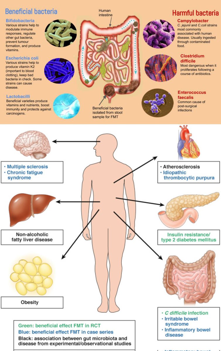 imedverse's tweet photo. Fecal microbiota transplantation

#TipsForNewDocs #MedEd #MedTwitter #medicine #medical #medicare #health #healthcare #FOAMed #ClinicalPearl #clinicaltips #MedStudents #microbiota #FMT 

Congratulations to @Sthanu5 🍾🥂 https://t.co/luaRo1EjnP