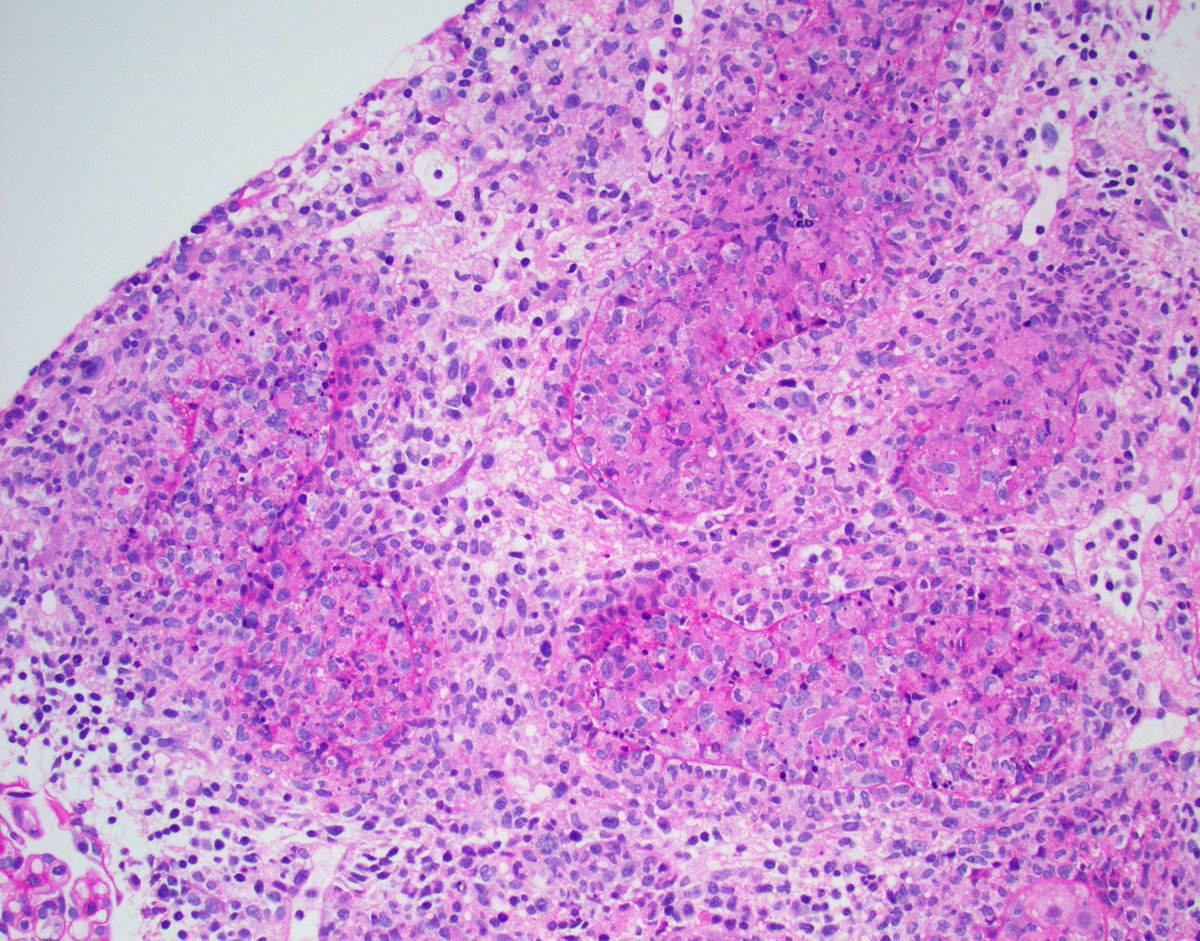 #Askrenalpath Anyone ever seen TBM and nuclear IgG staining by IF with adenovirus nephropathy? C1q staining also pictured. Similar the deposits with BK. #renalpath #PathTwitter