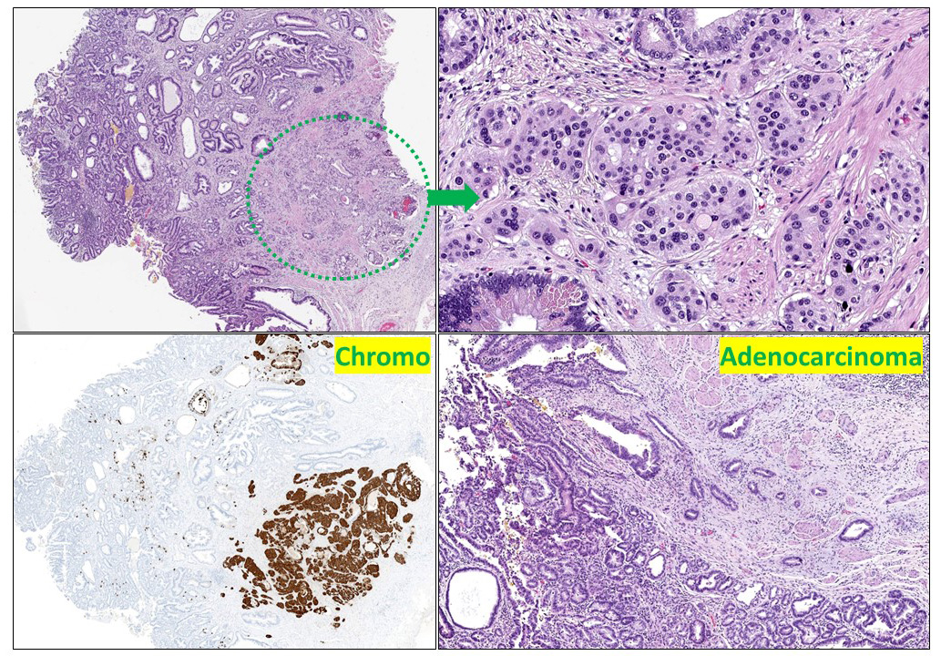 OlcaBasturk's tweet image. Case of the year! How many well differentiated #NET of #gallbladder have you seen? It is extremely rare. And how many of them also had an #adenocarcinoma? My first case in 22 years! #Pathology never fails to highlight my day...