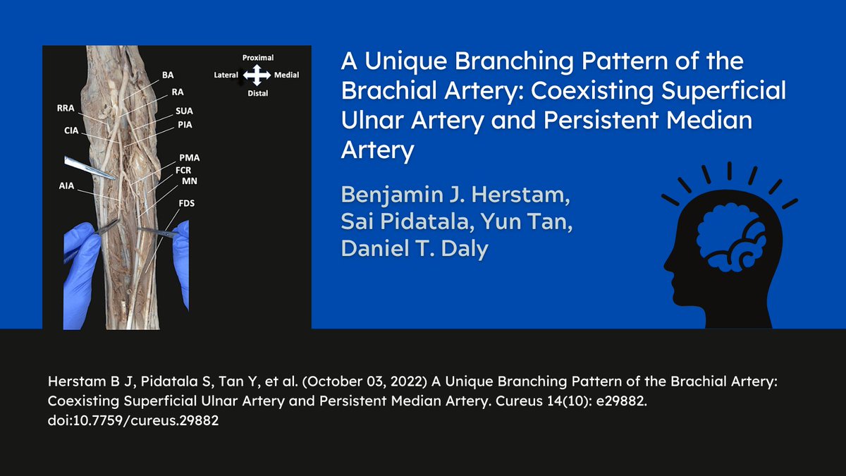 SLU_Anatomy's tweet photo. New article published by CASE @SLU_Anatomy graduate students Ben Herstam and Sai Pidatala, under the direction of Dr. Tan and Dr. Daly!
#anatomy #research #publication #gradstudent #anatchat #medtwitter
https://t.co/loN8I7fO60 https://t.co/poIHLWbBUs