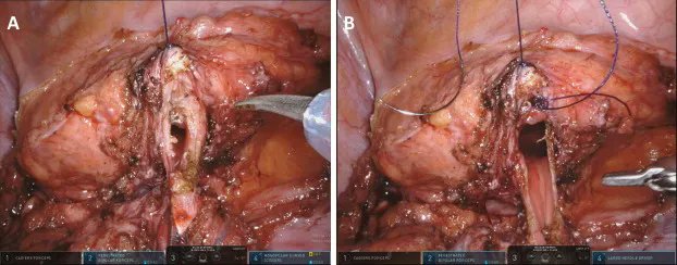 EurUrolOpen's tweet photo. Current issue: Robot-assisted Bladder Diverticulectomy Using a Transperitoneal Extravesical Approach
https://t.co/UqRRRrWkxy
@GGiannarini @MartaRossanese @DrMacchione @AlessandroCres @FicarraVincenzo
#openscience #openaccess #surgeryinmotion https://t.co/j7P80JDJCL