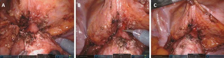 EurUrolOpen's tweet photo. Current issue: Robot-assisted Bladder Diverticulectomy Using a Transperitoneal Extravesical Approach
https://t.co/UqRRRrWkxy
@GGiannarini @MartaRossanese @DrMacchione @AlessandroCres @FicarraVincenzo
#openscience #openaccess #surgeryinmotion https://t.co/j7P80JDJCL