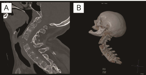 ¿Vas al quiropráctico? Pues cuidado con los 'chasquidos'. Aquí os dejo una fractura cervical con disección de la arteria vertebral e infarto del cerebelo tras manipulación. Tan loco es el caso que ha sido publicado por dos servicios de un mismo hospital. bit.ly/3z8eepO