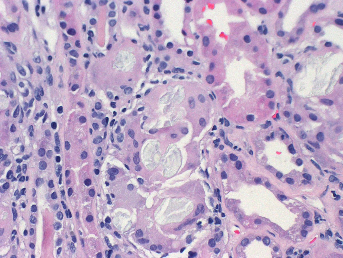 Patient with prior Roux-en-Y gastric bypass and now with renal dysfunction. Frequent oxalate crystals.  Associated cellular reaction and inflammation as well as some scarring. Widespread tubular injury. Oxalate nephropathy likely 2/2 malabsorption from bypass. #RenalPath