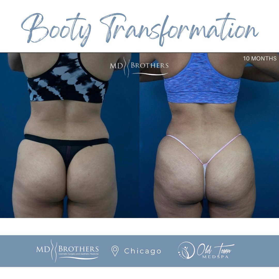 It's BOOty day at Old Town Med Spa- Contact us to schedule a free consultation about how we can sculpt your booty. #bootyday #butttransformation #buttfiller #medspachicago #cosmeticsurgeon #BBL #nonsurgicalBBL