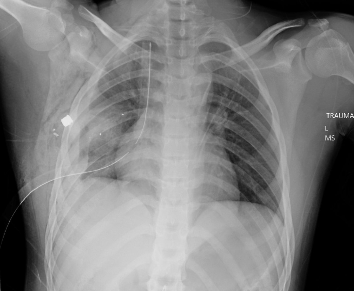 Here’s the Chest X-Ray of a teenager being treated for a condition that is endemic in the United States 

What’s the diagnosis?